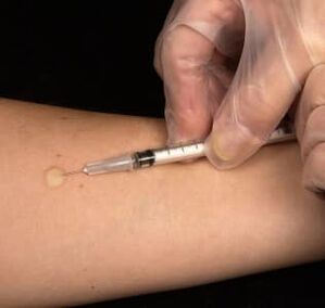 Subcutaneous injection of testosterone